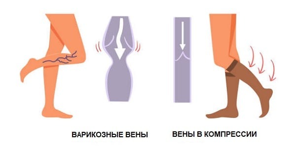 выбрать компрессионные колготки